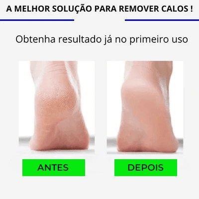 Skin Pro™ - Removedor de calos - Sports Pro